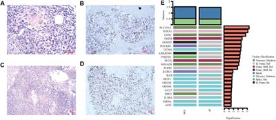 Case report: Squamous cell carcinoma of the prostate-a clinicopathological and genomic sequencing-based investigation